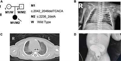 Novel compound heterozygous CCDC40 mutations in a familial case of primary ciliary dyskinesia